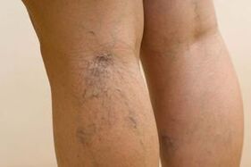 Wie Krampfadern bei Frauen manifestieren