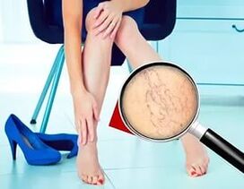 Die Symptome hängen von der Art und dem Stadium der Krampfadern ab.