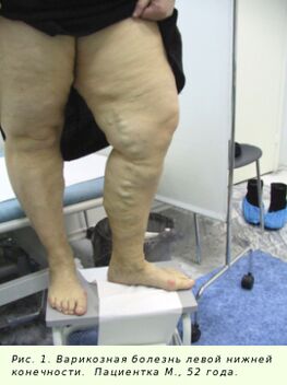 Krampfadern müssen behandelt werden, um den Prozess zu stoppen.