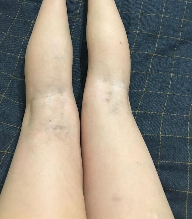 Manifestationen von Krampfadern in den Beinen.